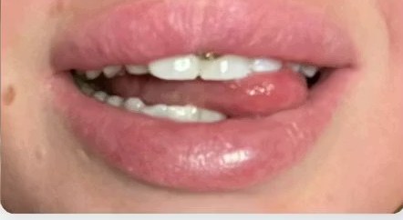 Jill Larssons Zähne nach der Bleaching-Kur