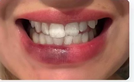 Wilda Bogrens Zähne vor der Bleaching-Kur